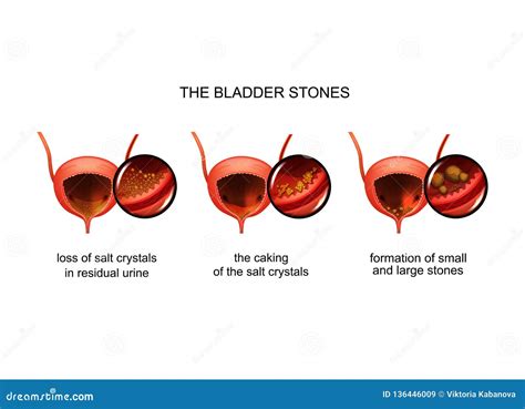 Bladder Stones. Cross Section Royalty-Free Illustration | CartoonDealer.com #278298951