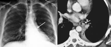 Lung Carcinoid Tumor Imaging: Practice Essentials, Radiography, Computed Tomography