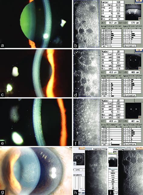 Specular Microscopy in Fuchs endothelial corneal dystrophy: (a and b ...