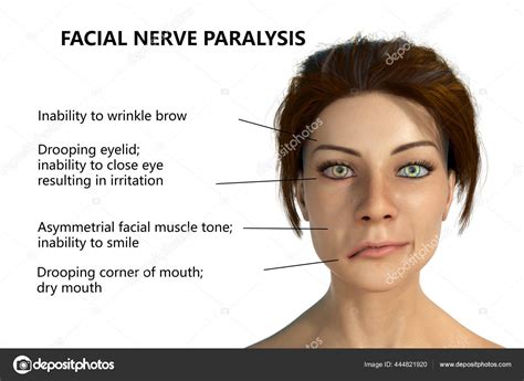 Facial Nerve Paralysis Bell's Palsy Illustration Showing Female One ...