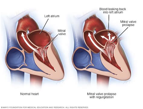 Guide To Heart Murmurs: Mitral Regurgitation Murmur - Stepwards