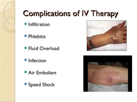 IV complications | Iv therapy, Air embolism, Therapy