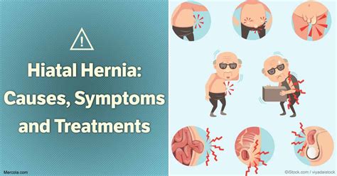 Hiatal Hernia Symptoms Causes Treatment – NBKomputer