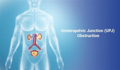 An Overview of Ureteropelvic Junction (UPJ) Obstruction