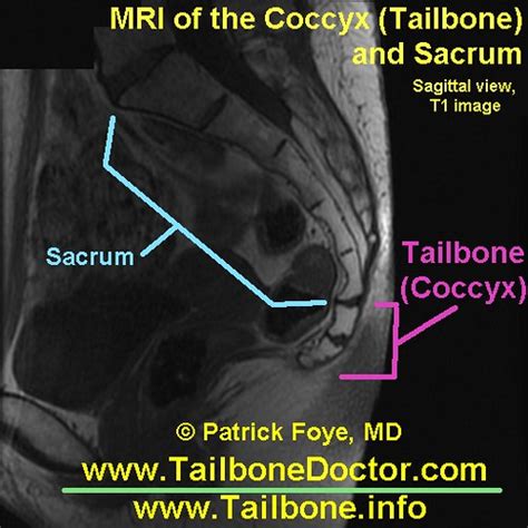 Tailbone MRI coccyx pain Foye | Tailbone MRI (Coccyx MRI), i… | Flickr