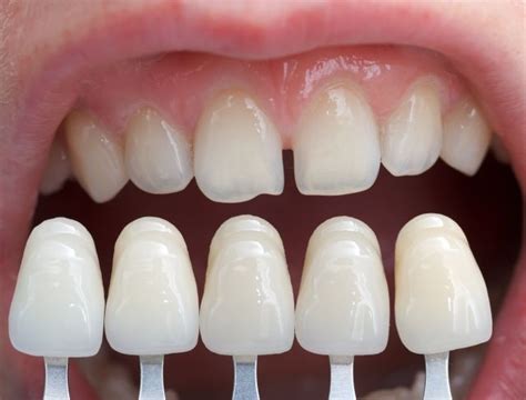 How to look after your composite resin veneers, 4 great tips! - Dentist ...