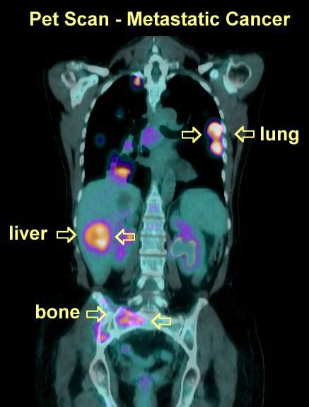 PET Scans in Cancer Cases