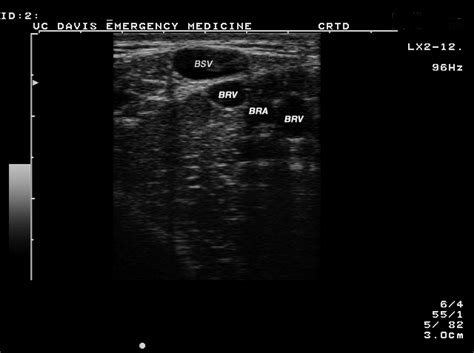 A Randomized Controlled Trial Comparing One-Operator Versus Two-Operator Technique in Ultrasound ...