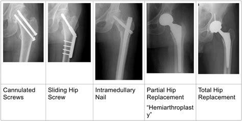 HIP FRACTURE – Dr. Jonathan R. Danoff, MD., Orthopedic Surgeon