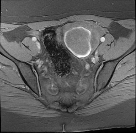 √ Uterus Endometriosis Ct Scan / Tumors Of The Uterine Corpus Clinical Gate : The best way to ...