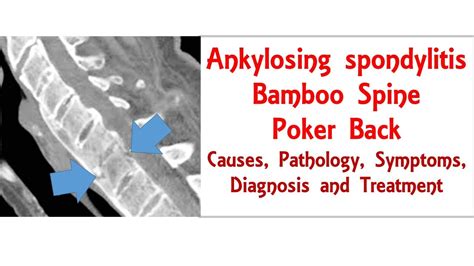 Ankylosing spondylitis/ bamboo spine/ poker back: causes, pathology, symptoms, diagnosis ...