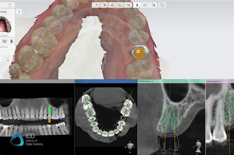 How to 3D Print Implant Surgical Guides for Stress-Free Implant ...