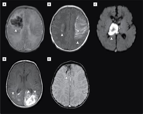 What Is The Icd 10 Code For Subdural Hematoma