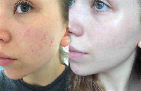 [Acne] Before and After: Using Clinique's Even Better Clinical Dark ...