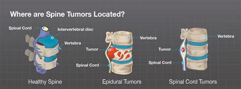 What are Spine Tumors? - Brainlab.org