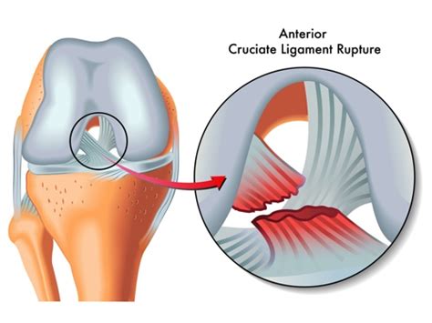 ACL Rupture - Orthopaedics 360