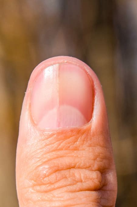 7 Fingernail Health Signs That You Should Be Wary Of