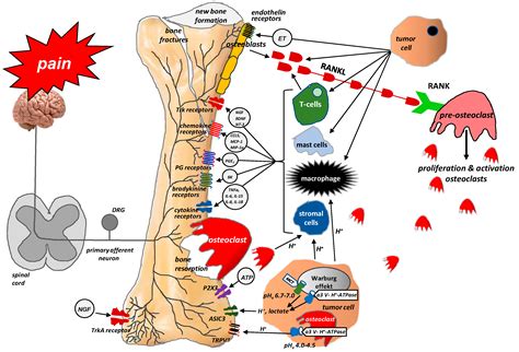 IJMS | Free Full-Text | Bone Pain in Cancer Patients: Mechanisms and ...