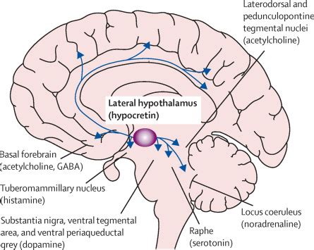 Narcolepsy Brain Damage