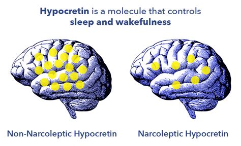 Hypersomnia — Symptoms, Causes, and Treatments | Sleepopolis