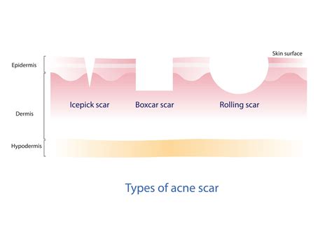 Types of Acne Scars and How To Treat Them