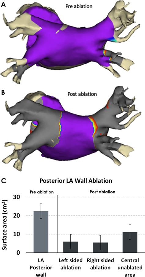 Lesion characterization. Example of the pre- (A) and post-ablation (B ...