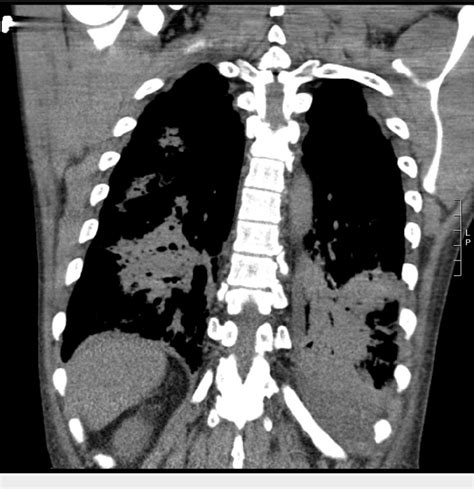 Figure 1 from Human Metapneumovirus Pneumonia Precipitating Acute ...