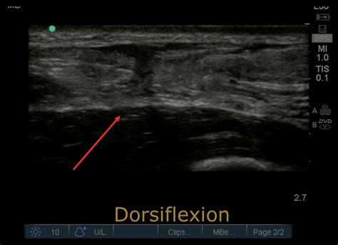 Ultrasonographic Findings of Acute Achilles Tendon Rupture - JETem