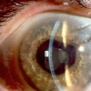 (PDF) Diagnosis and treatment of enthesitis-related arthritis