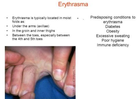 Erythrasma - Treatment, Photos, What Is?, Symptoms, Types, Causes