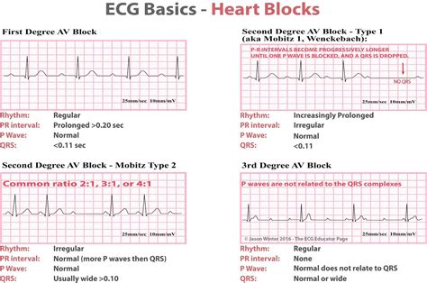 ECG Basics - Heart... - Clinical Anatomy & Operative Surgery