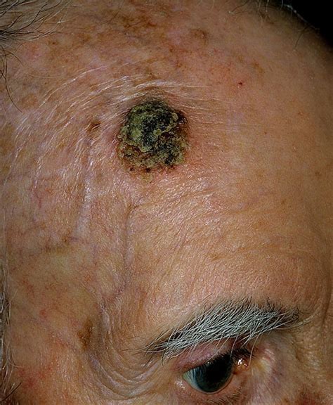 Signs of Skin Cancer Pictures – 48 Photos & Images / illnessee.com