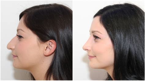 Nose Surgery (Rhinoplasty) | Dr Michael Miroshnik