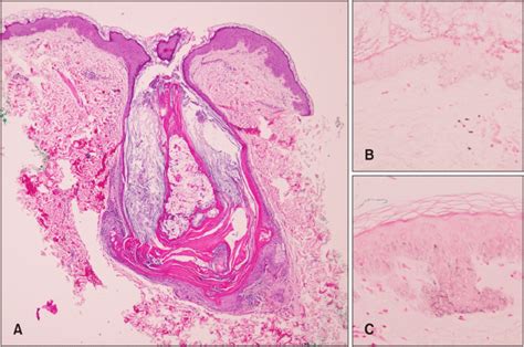 (A) Hyperkeratosis and dilated follicular infundibulum with keratotic ...