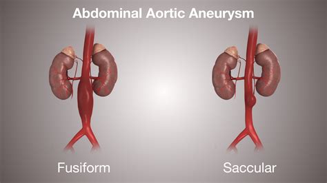 ABDOMINAL AORTIC ANEURYSM: Symptoms, Causes & Treatment - Scientific Animations