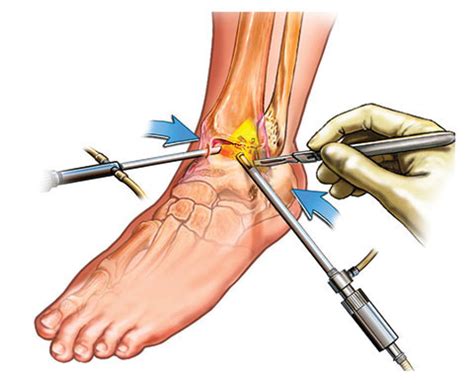 Surgery for Ankle Arthritis | Murdoch Orthopaedic Clinic