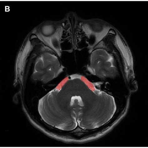 | An example of ROI views on MRI. (A) cerebellopontine cisterns, (B)... | Download Scientific ...