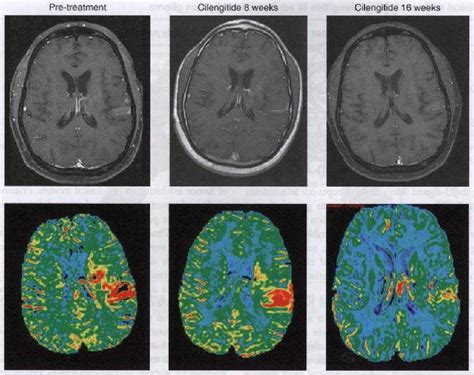 The perfusion MRI method of dynamic contrast susceptibility was used to... | Download Scientific ...