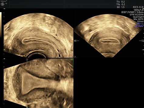 The Assessment, Diagnosis and Causes of Endometrial Cancer | Empowered Women's Health