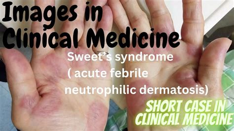 Short Case in Medicine: Sweet's Syndrome(Acute Febrile Neutrophilic Dermatosis) in a Patient ...