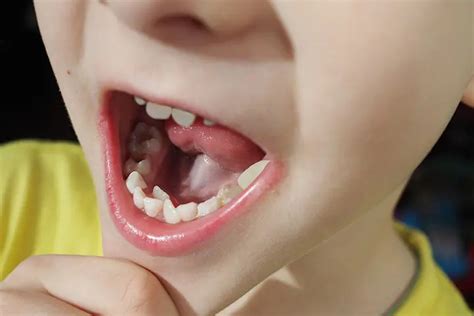 Hyperdontia In Children: Types, Causes, Signs, And Treatment