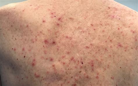 Is my skin rash a COVID-19 symptom?