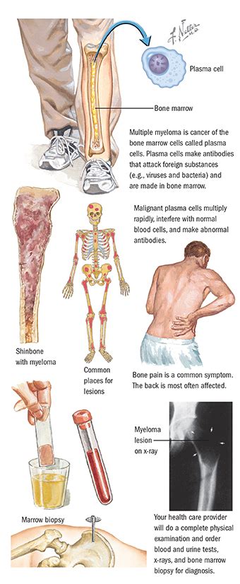 About Myeloma | Blood Cancer | Spectrum Health