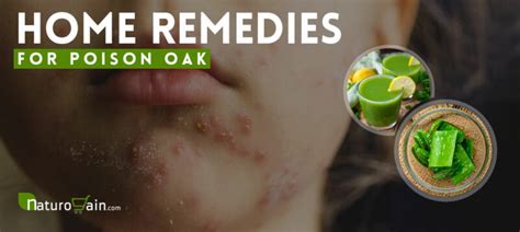 9 Best Home Remedies for Poison Oak to Prevent Allergic Reaction