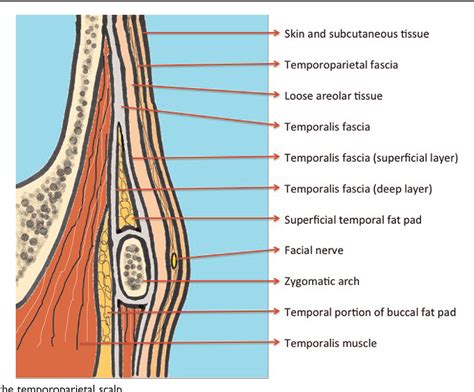 Safety of Modified Coronal Approach with Dissection Deep to Temporalis Fascia for Facial Nerve ...