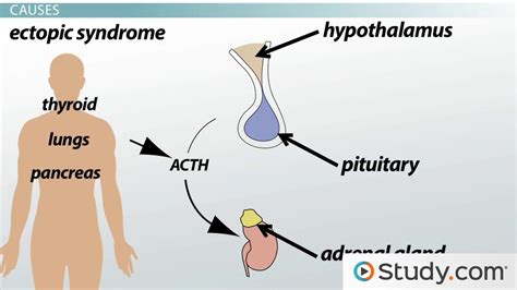 Cushing's Syndrome: Causes, Signs & Treatments - Lesson | Study.com