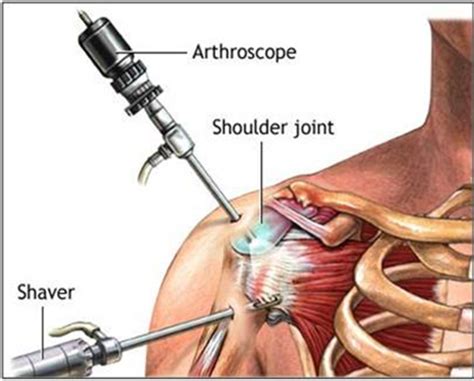 Impingement syndrome | Brisbane Knee and Shoulder ClinicBrisbane Knee and Shoulder Clinic