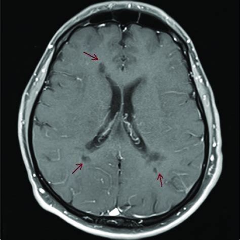 MRI-Brain with contrast T1 showing multiple MS lesions, no contrast ...