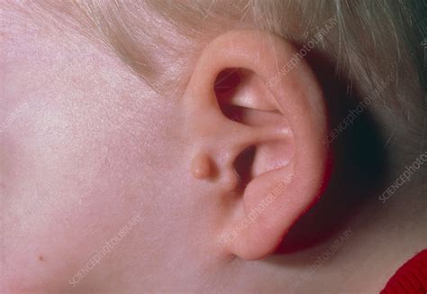 Auricular (ear) appendage: a congenital deformity - Stock Image - M350 ...