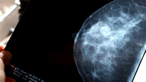 Women with dense breasts face dilemma of screening options beyond mammograms | CTV News